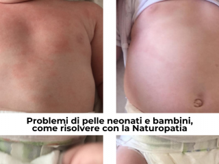 Problemi di pelle neonati e bambini, come risolvere con la Naturopatia