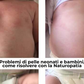 Problemi di pelle neonati e bambini, come risolvere con la Naturopatia